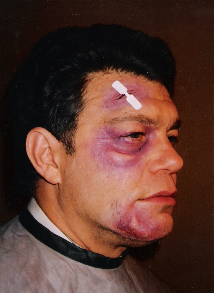 Al Franken, beaten and bruised for an episode of his 