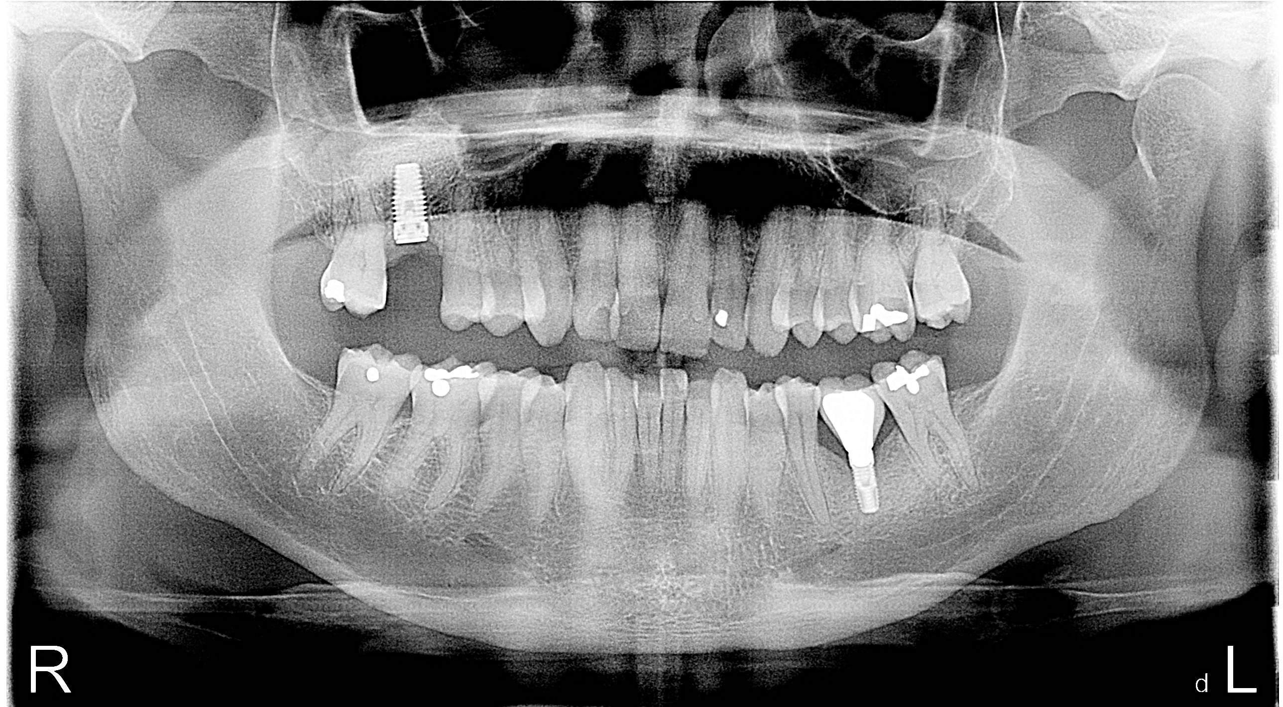 Very clearly identifiable dental records in case of fiery death.