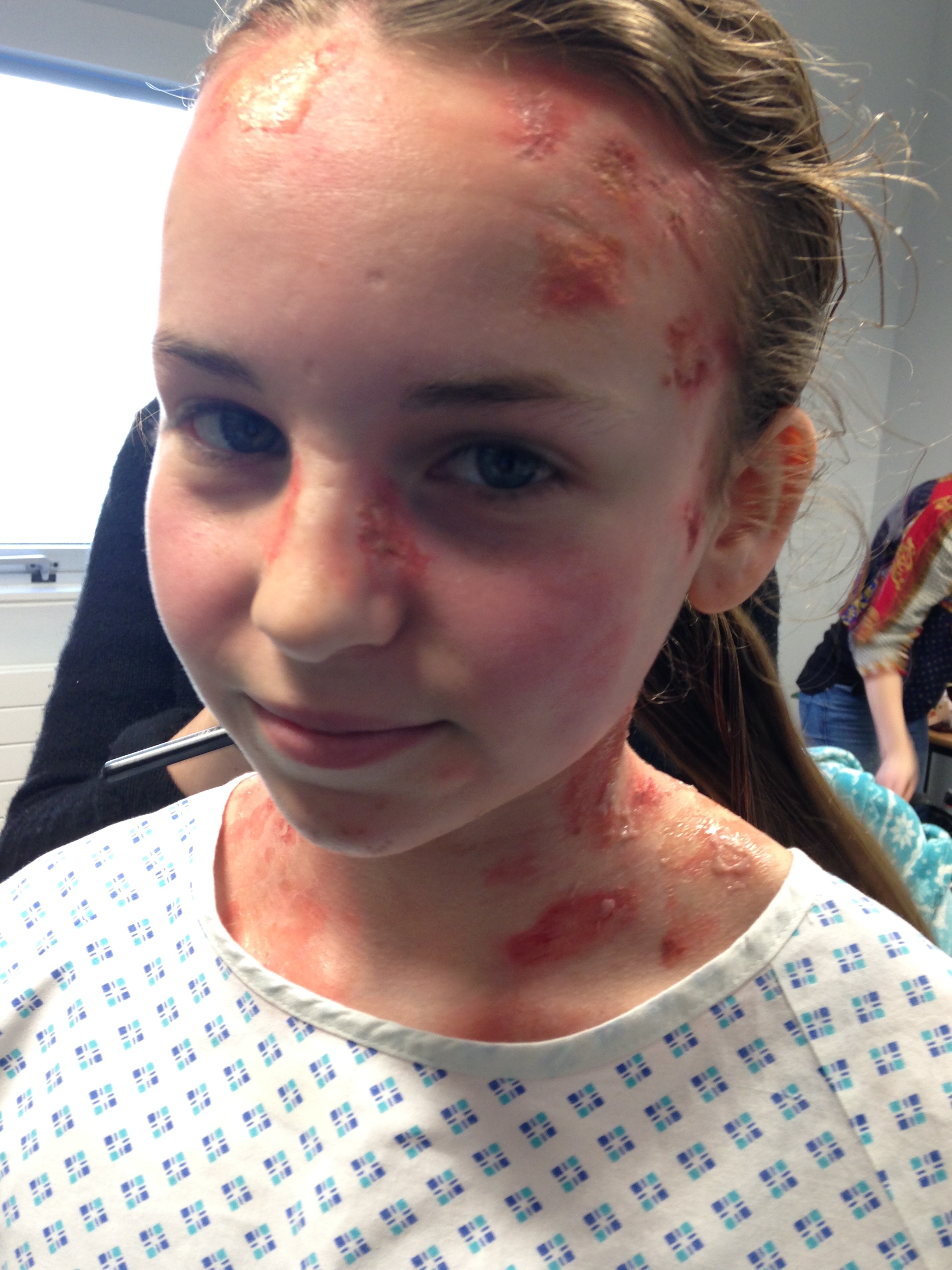 Having prosthetics and make up applied for her character's EB - Daisy