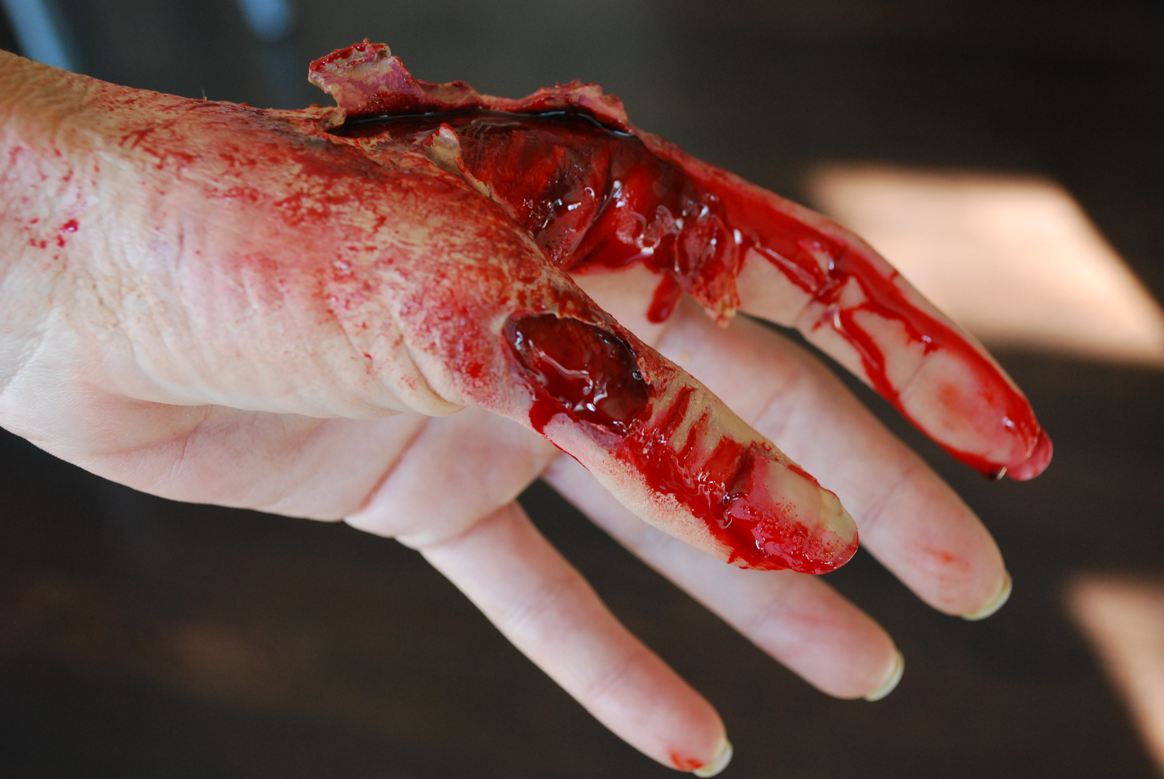 injured hand prosthetic by Loni Hale.