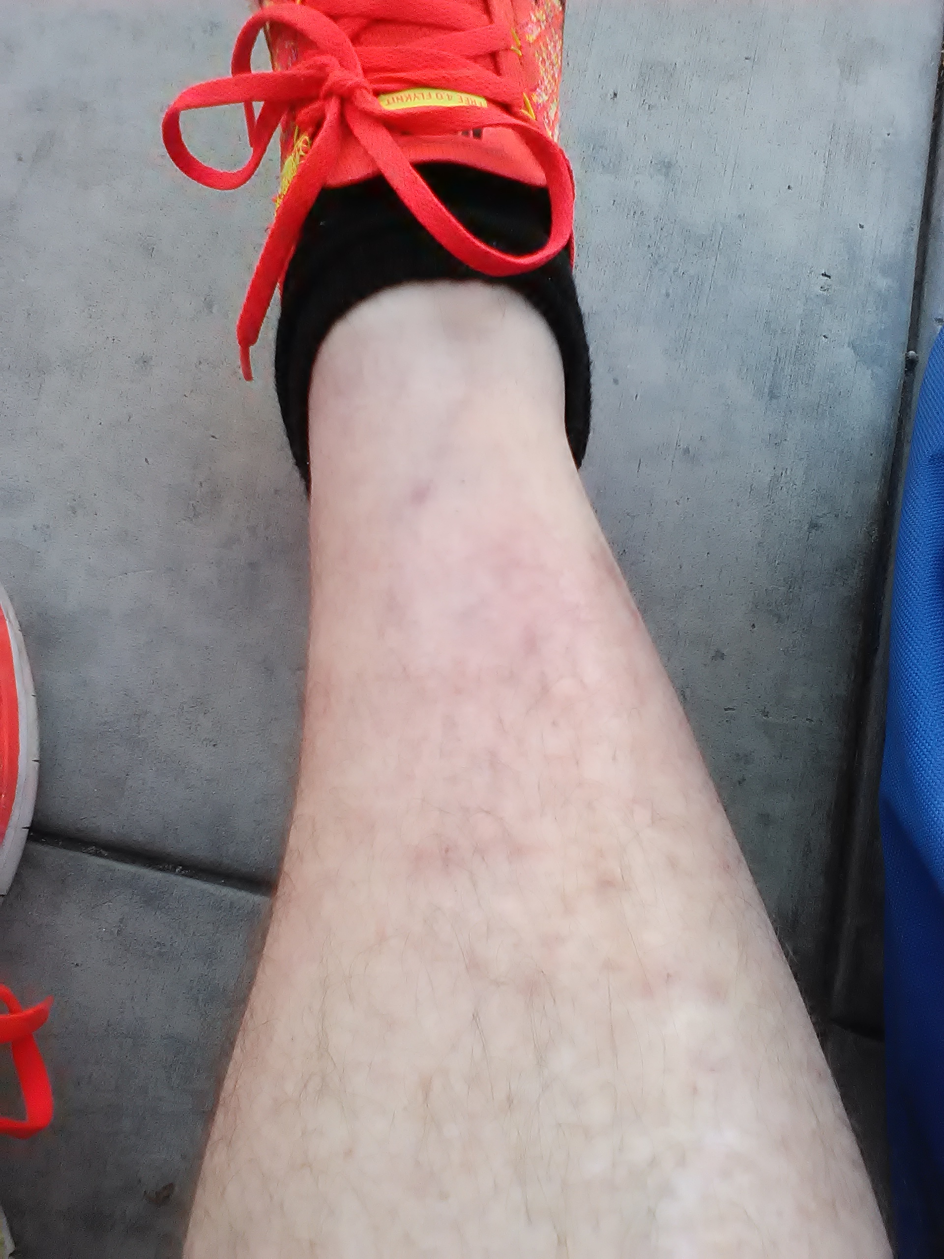 My legs healthy. Within 5 days in Jail blood flow cut off and sores appear and severe swelling.