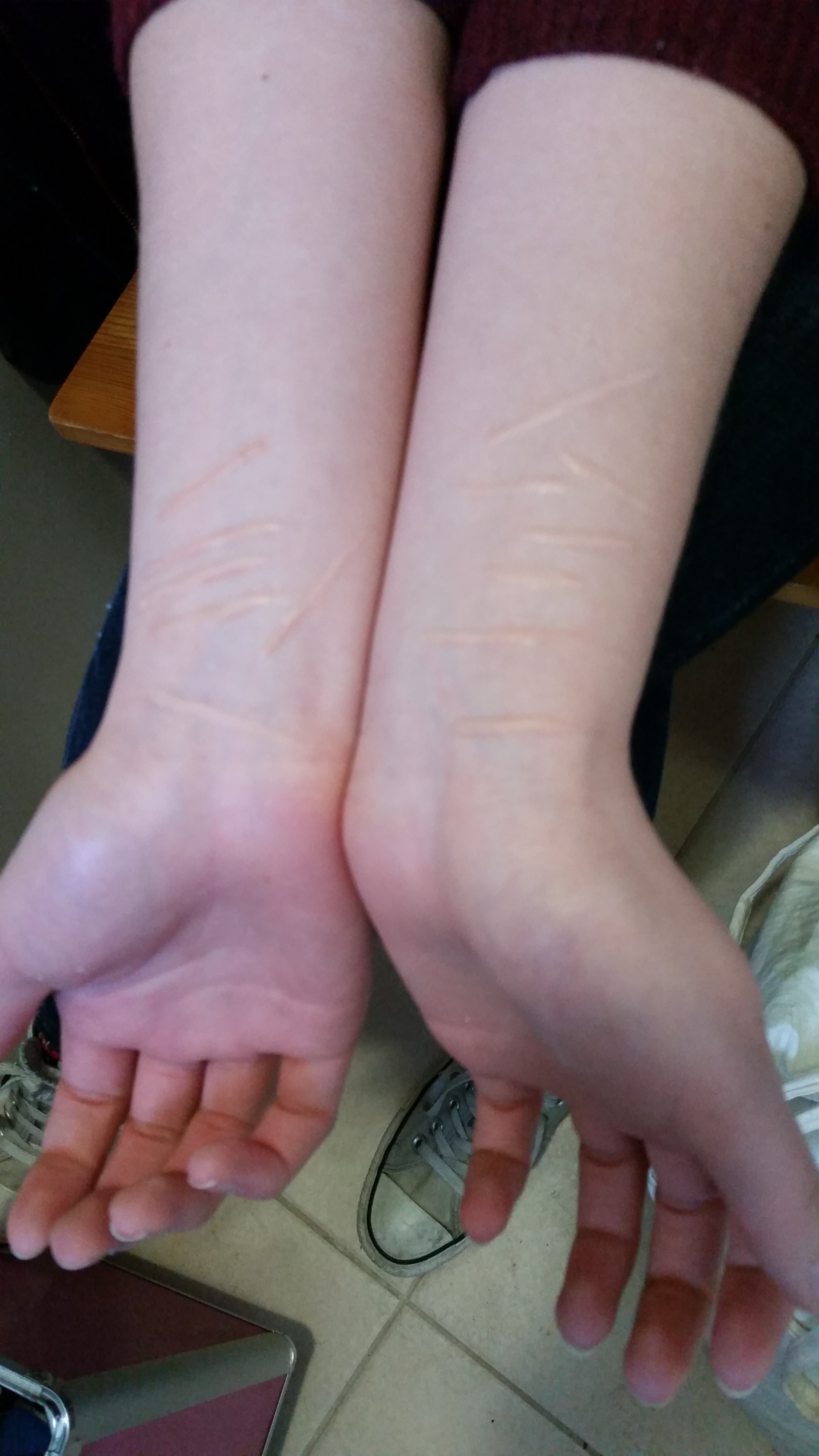 Self Harming Marks from 'The Voice' Short film, I done.