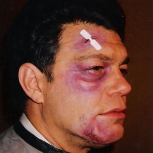 Al Franken beaten and bruised for an episode of his Lateline series Makeup by Norman Bryn