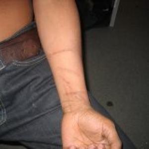 Arm scars
