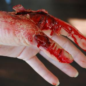 injured hand prosthetic by Loni Hale
