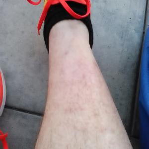 My legs healthy Within 5 days in Jail blood flow cut off and sores appear and severe swelling